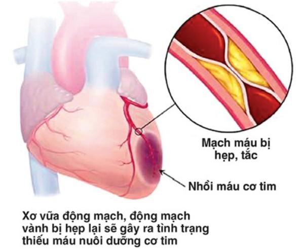 4 món ăn quý hơn thuốc dành cho người bị tăng huyết áp và bệnh mạch vành - 0