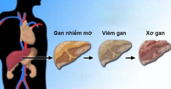 Xuất hiện 4 dấu hiệu cùng lúc báo hiệu bệnh xơ gan giai đoạn cuối