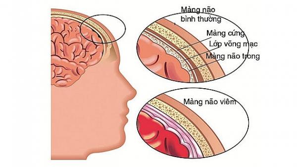 6 bệnh đặc biệt nguy hiểm cho trẻ trong ngày hè - 4