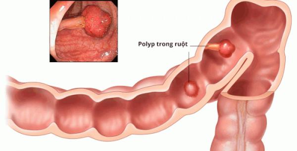 8 người mắc ung thư trong một gia đình, biện pháp nào cho việc phòng chống? - 0