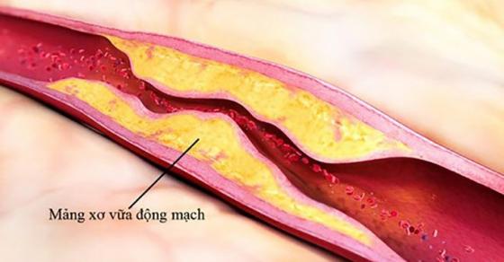 Tăng huyết áp và sự dẫn tới hình thành xơ vữa động mạch